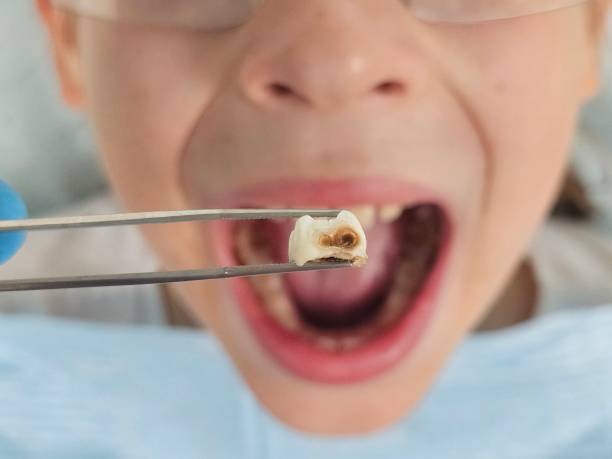 Best Emergency Wisdom Tooth Extraction in Sea Breeze, NC